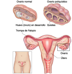 Ovario poliquistico